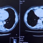 _75259156_lung.cancer.scan