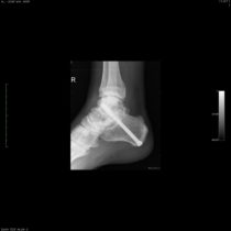 Subtalar Ankle Fusion