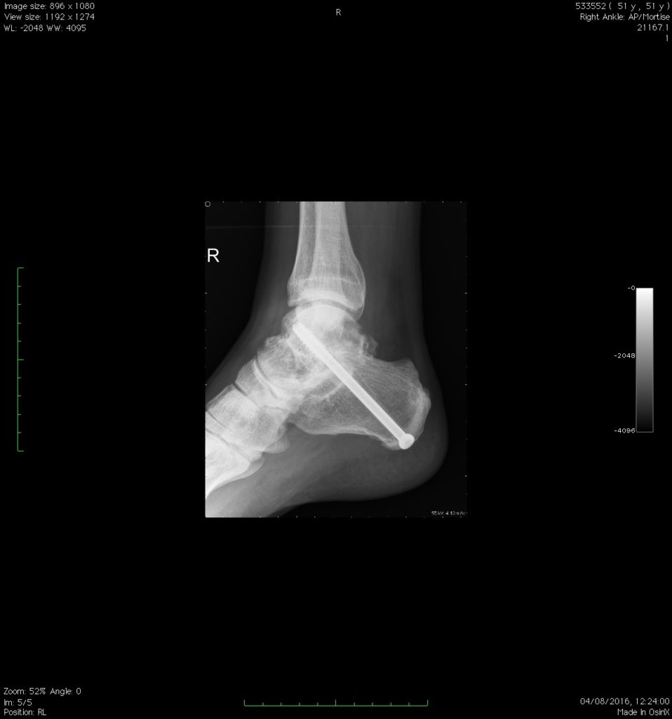 Subtalar Ankle Fusion