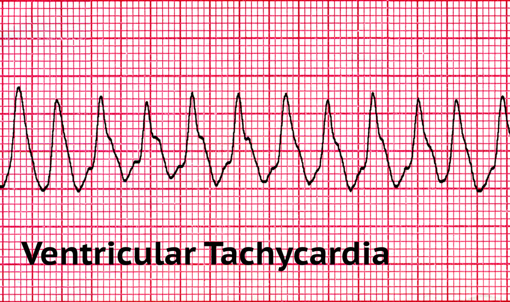 Pulseless Ventricular Tachycardia
