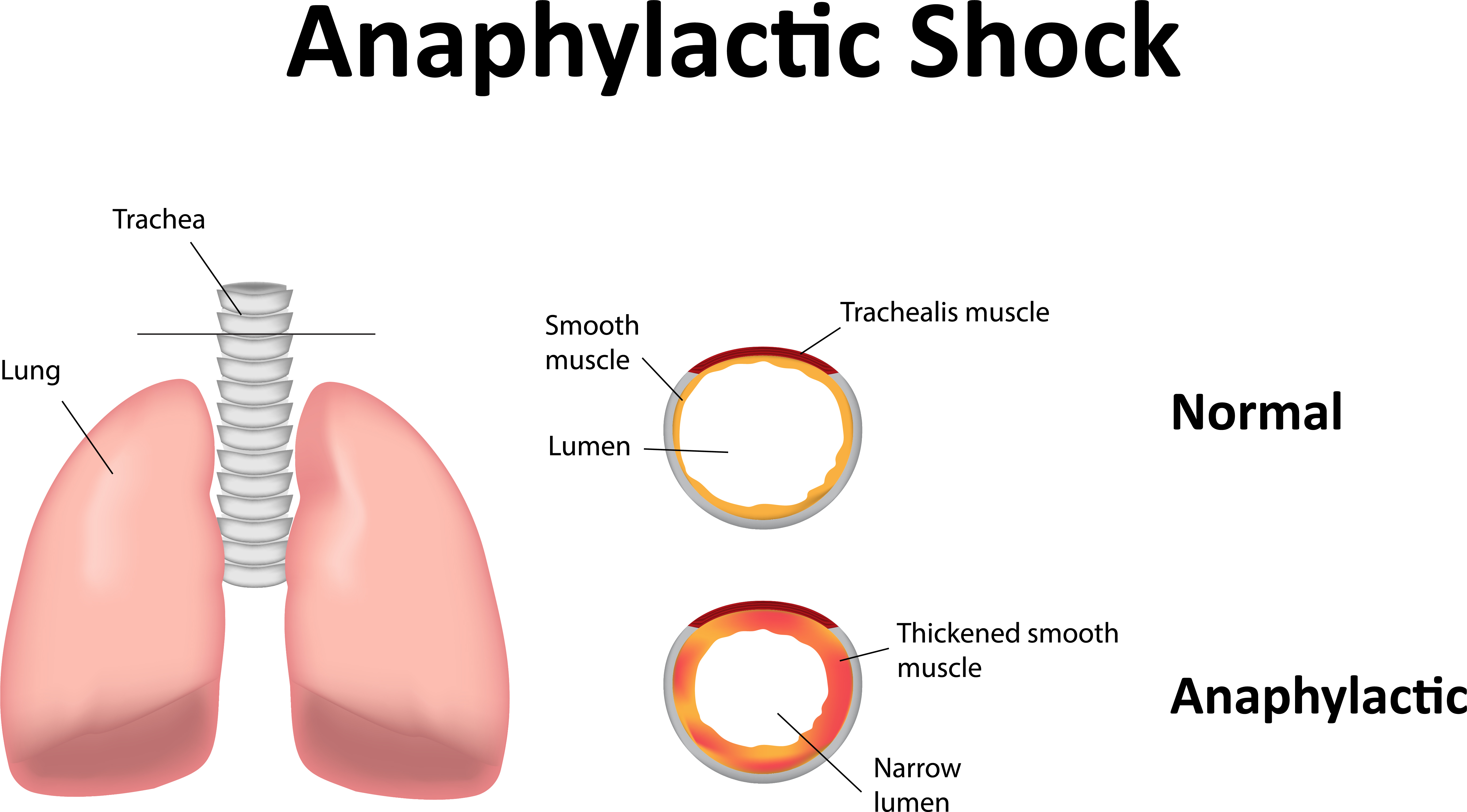 Idiopathic Anaphylaxis