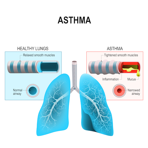 How Asthma Affects the Respiratory System