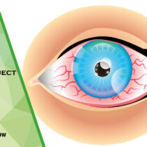foreign object in the eye